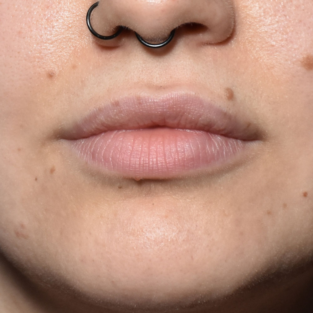 Case--2151 | After Facial Fillers 2