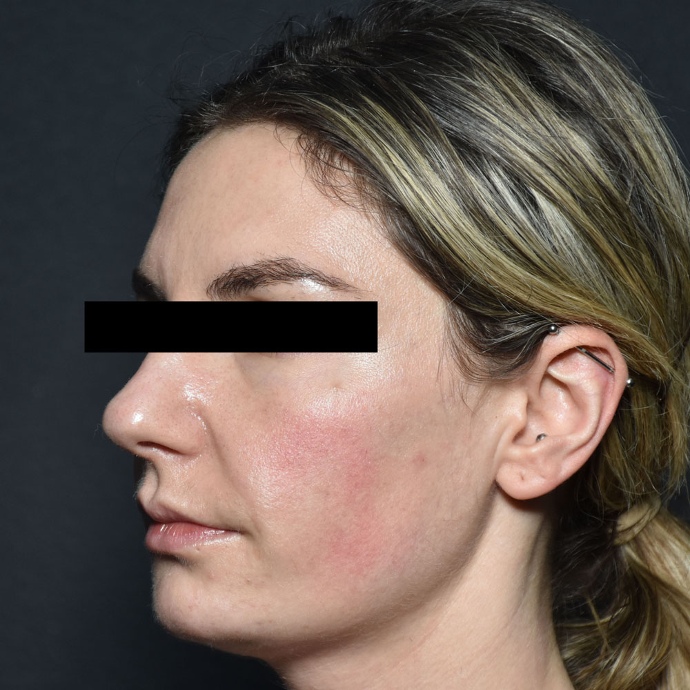 Case--2152 | Before Facial Fillers 2