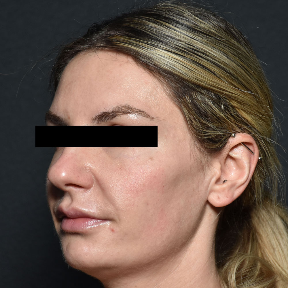 Case--2152 | After Facial Fillers 2