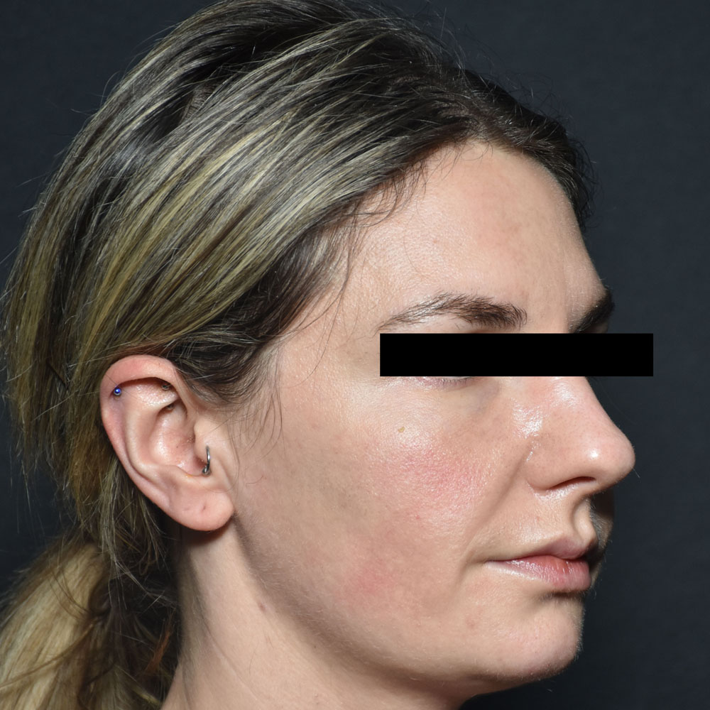 Case--2152 | Before Facial Fillers 3