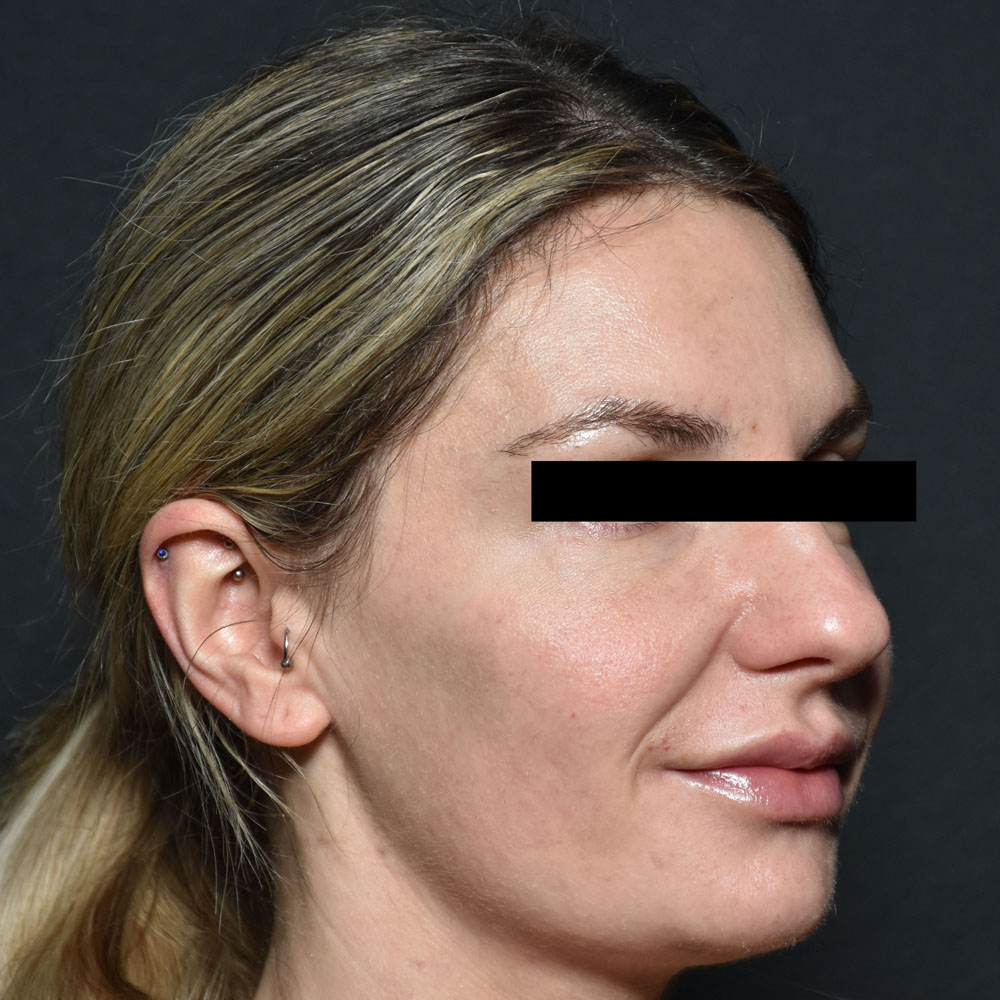 Case--2152 | After Facial Fillers 3