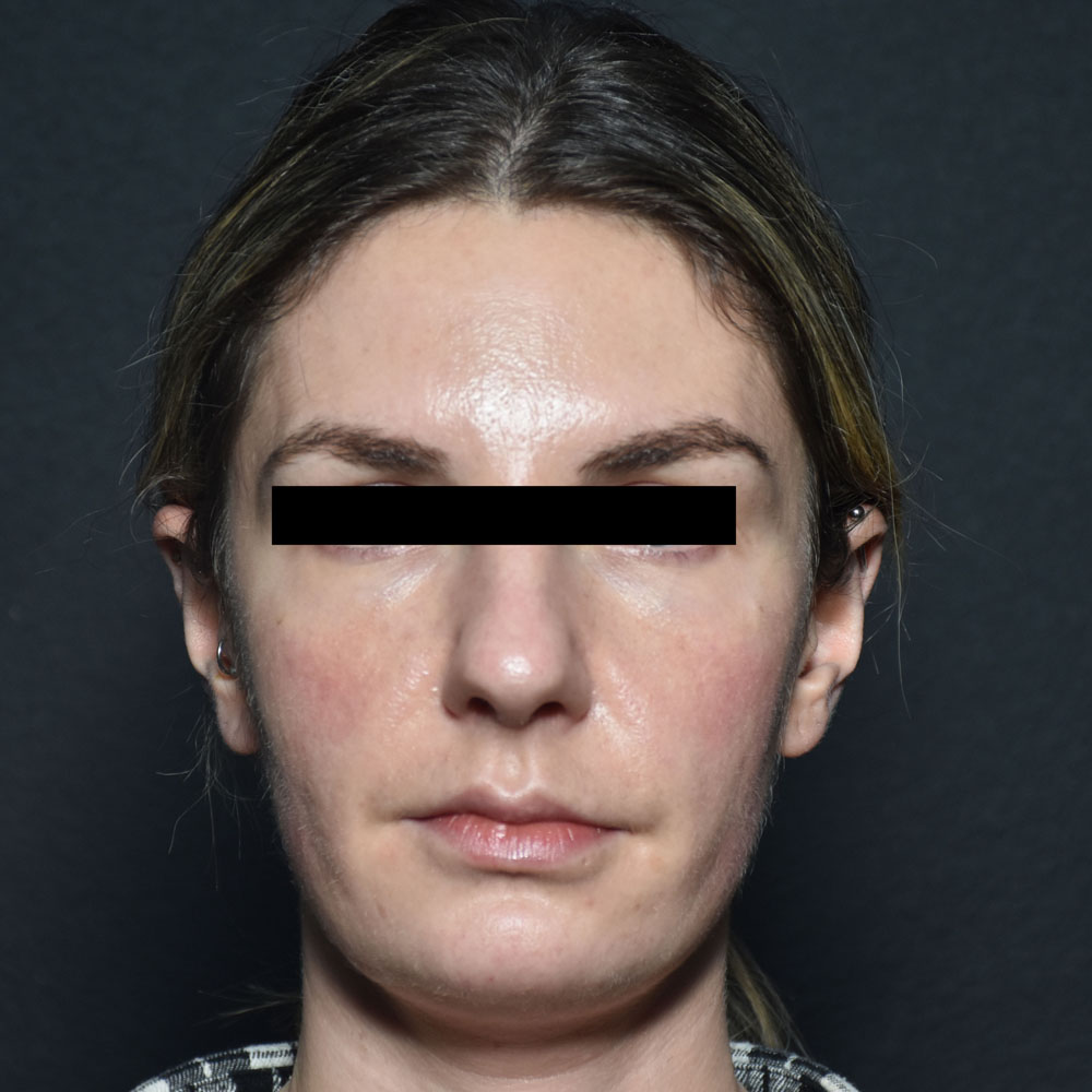 Case--2152 | Before Facial Fillers