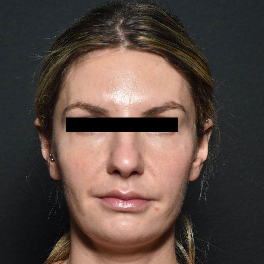 Case--2152 | After Facial Fillers