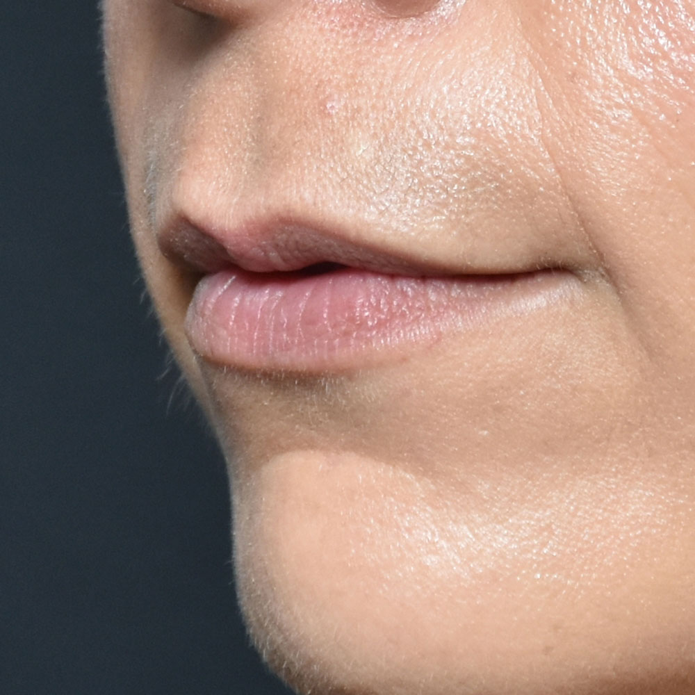 Case--2153 | Before Facial Fillers 2