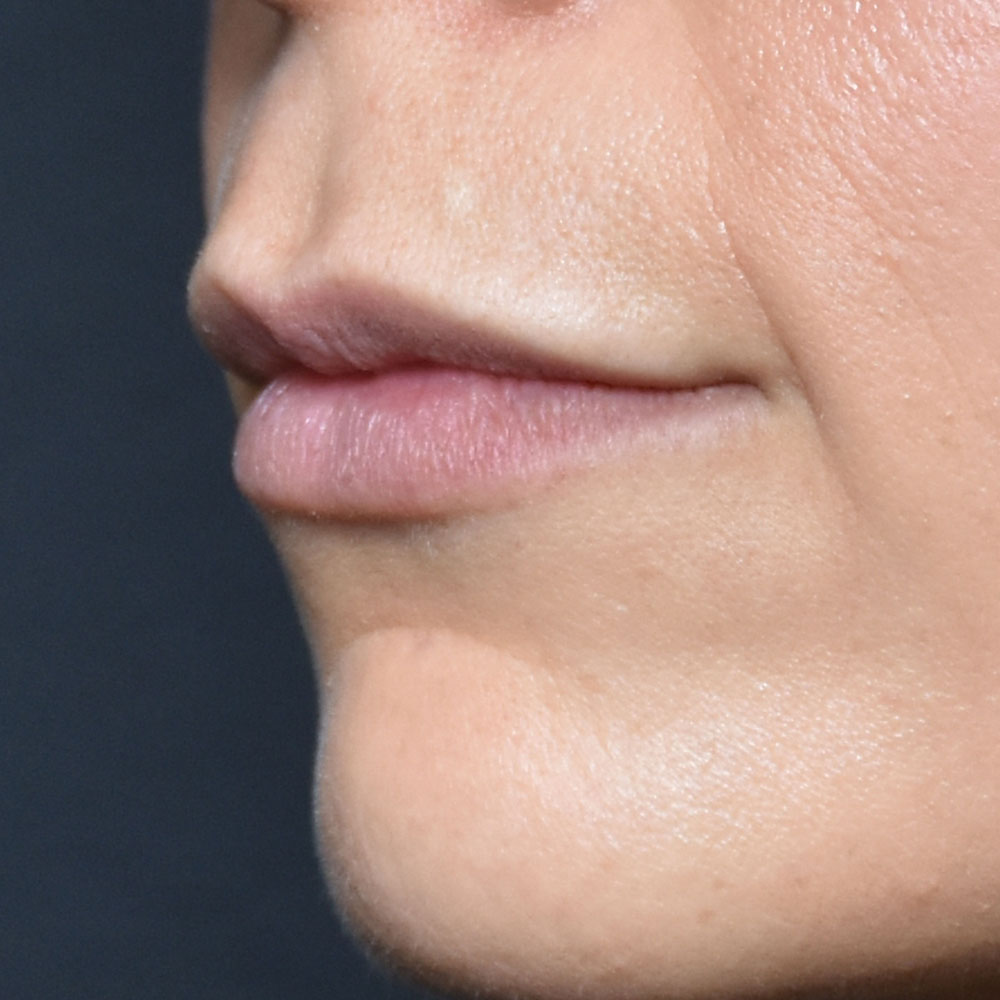 Case--2153 | After Facial Fillers 2