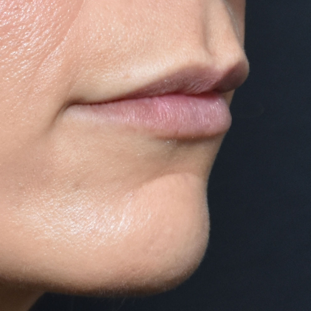 Case--2153 | After Facial Fillers 3