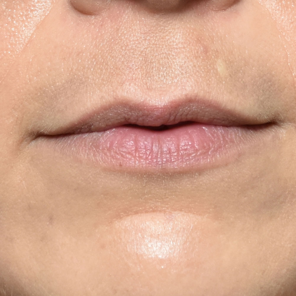 Case--2153 | Before Facial Fillers