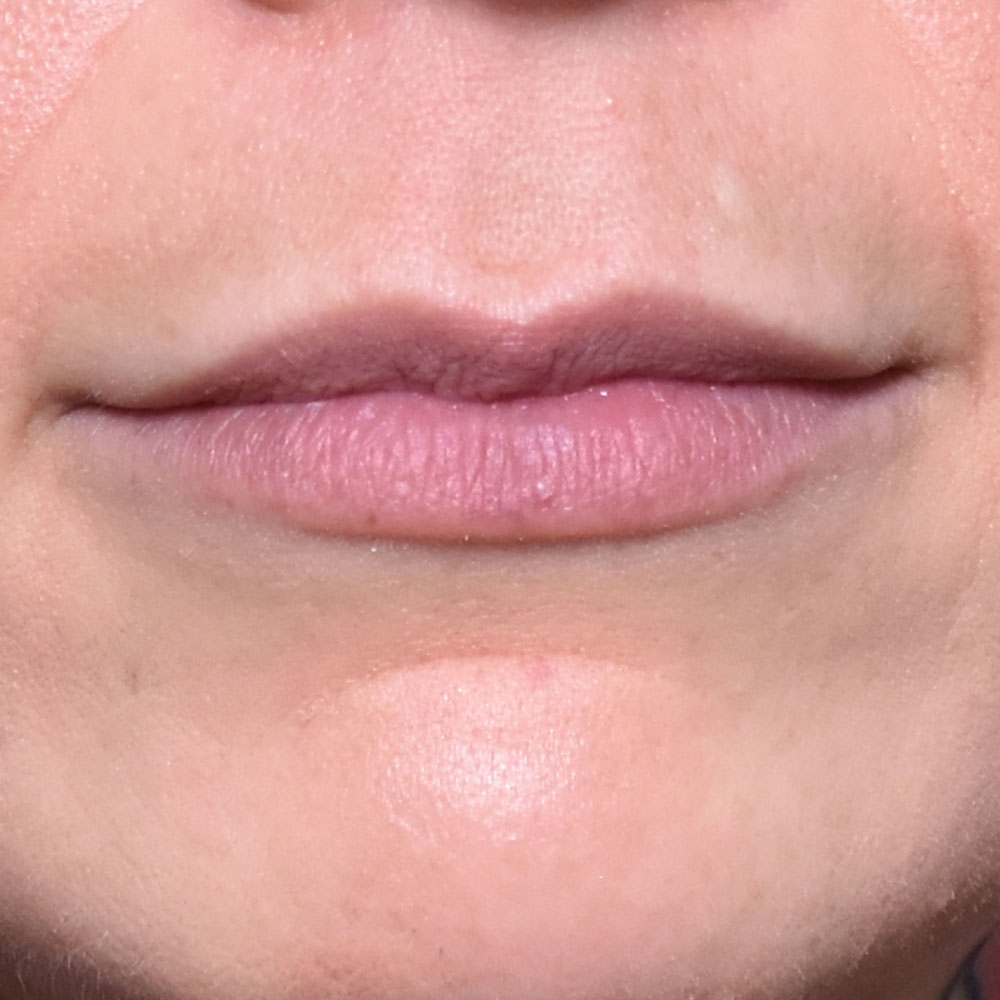 Case--2153 | After Facial Fillers