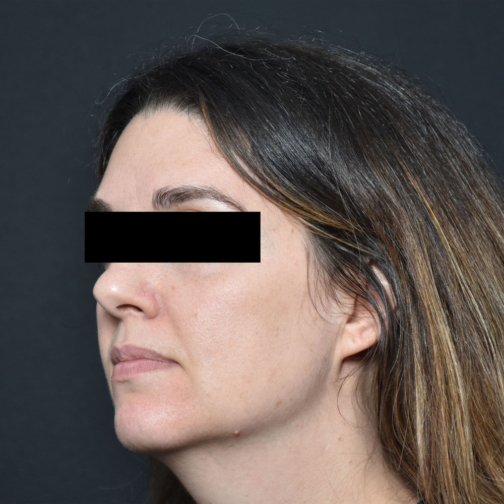 Case--2154 | Before Facial Fillers