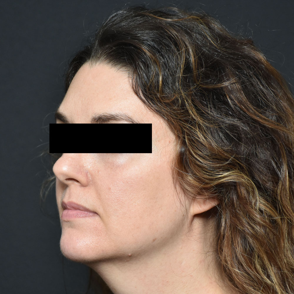 Case--2154 | After Facial Fillers