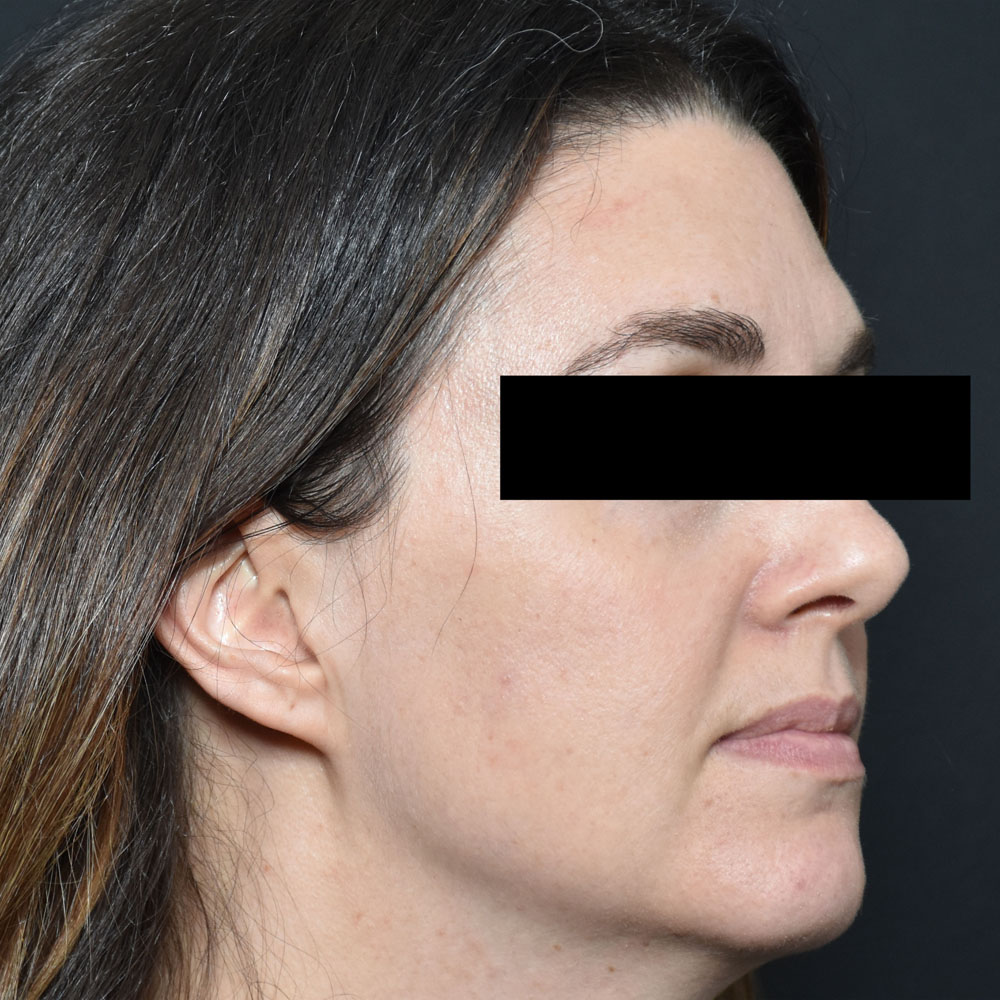 Case--2154 | Before Facial Fillers 2