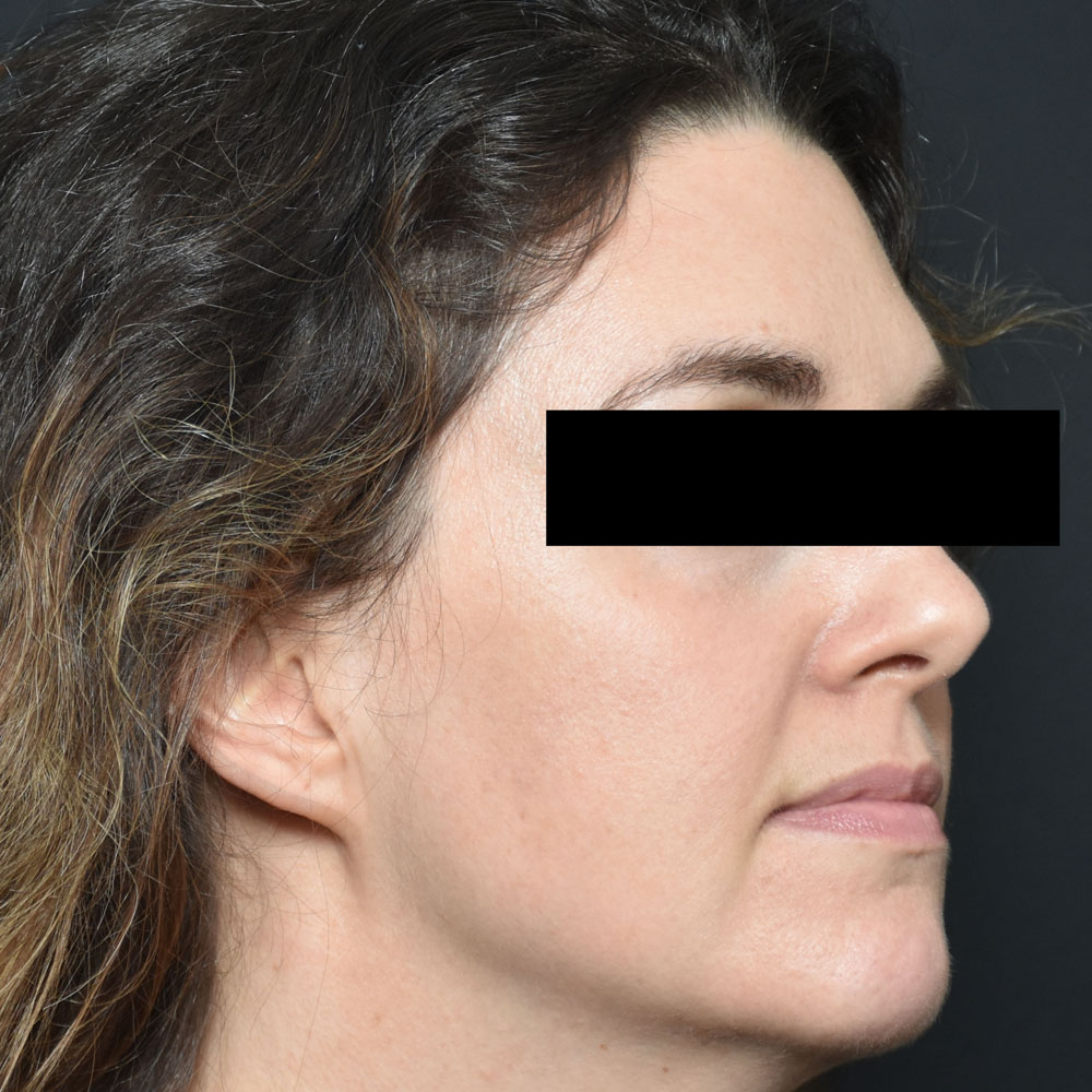 Case--2154 | After Facial Fillers 2