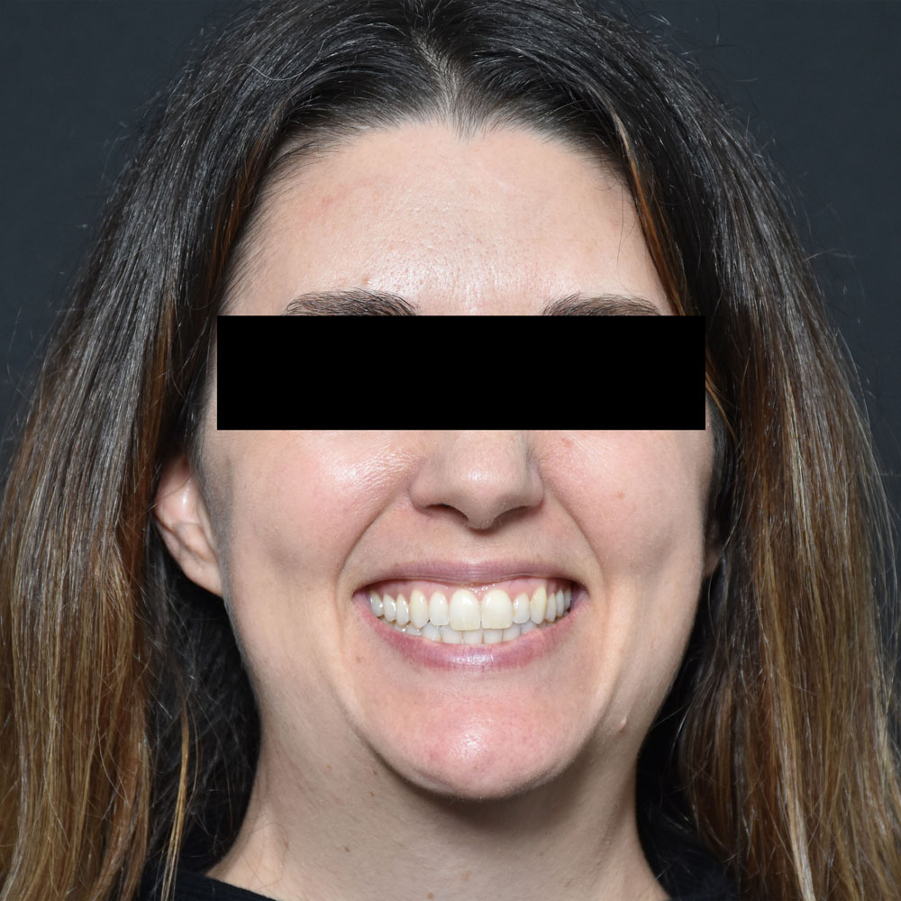 Case--2154 | Before Facial Fillers 3