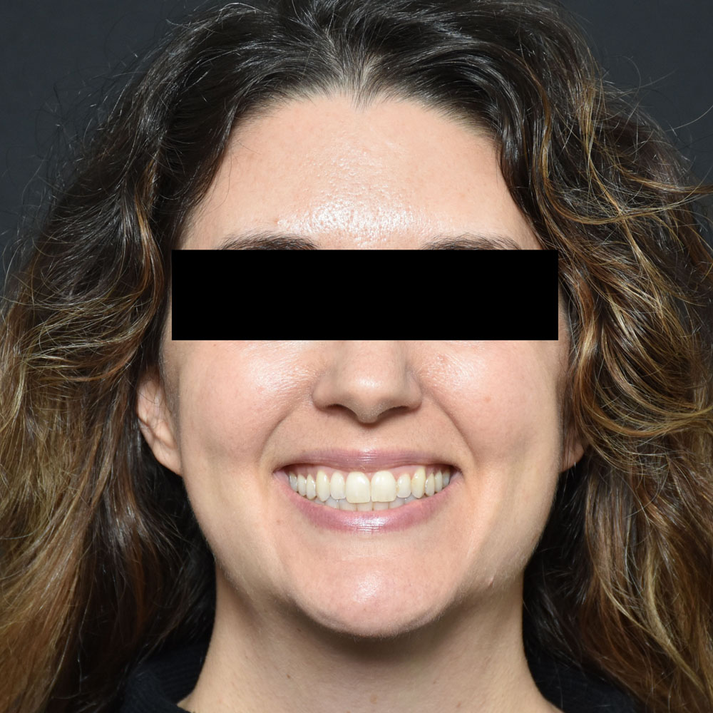 Case--2154 | After Facial Fillers 3