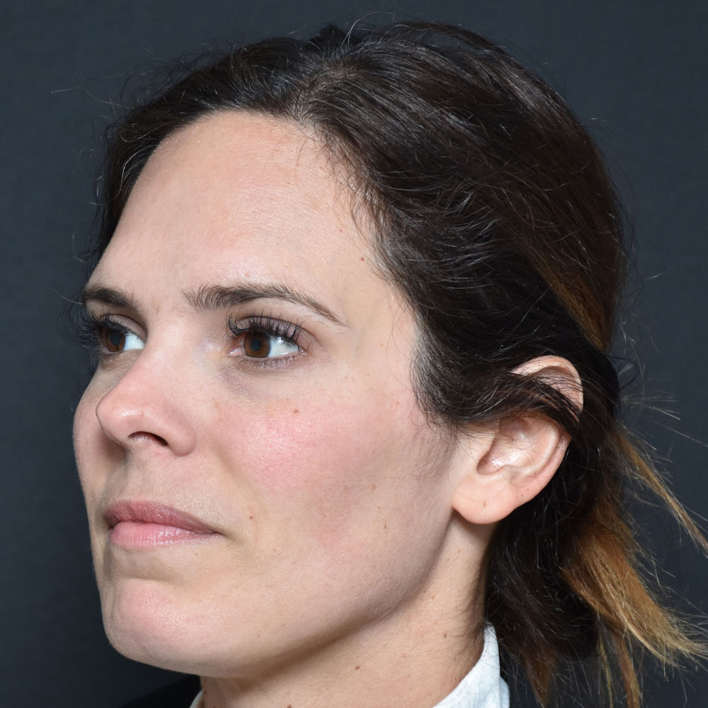 Case--2155 | Before Facial Fillers 2