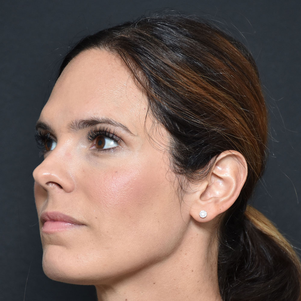 Case--2155 | After Facial Fillers 2