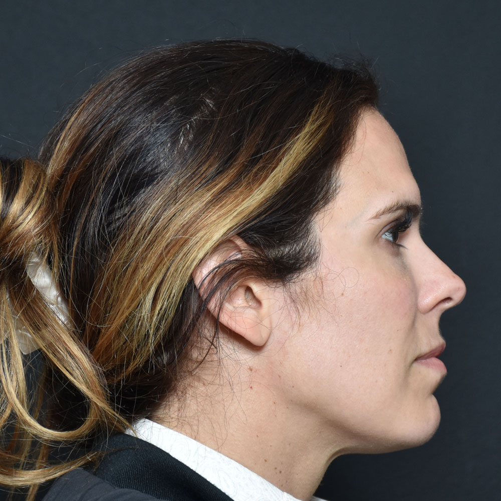 Case--2155 | Before Facial Fillers 3