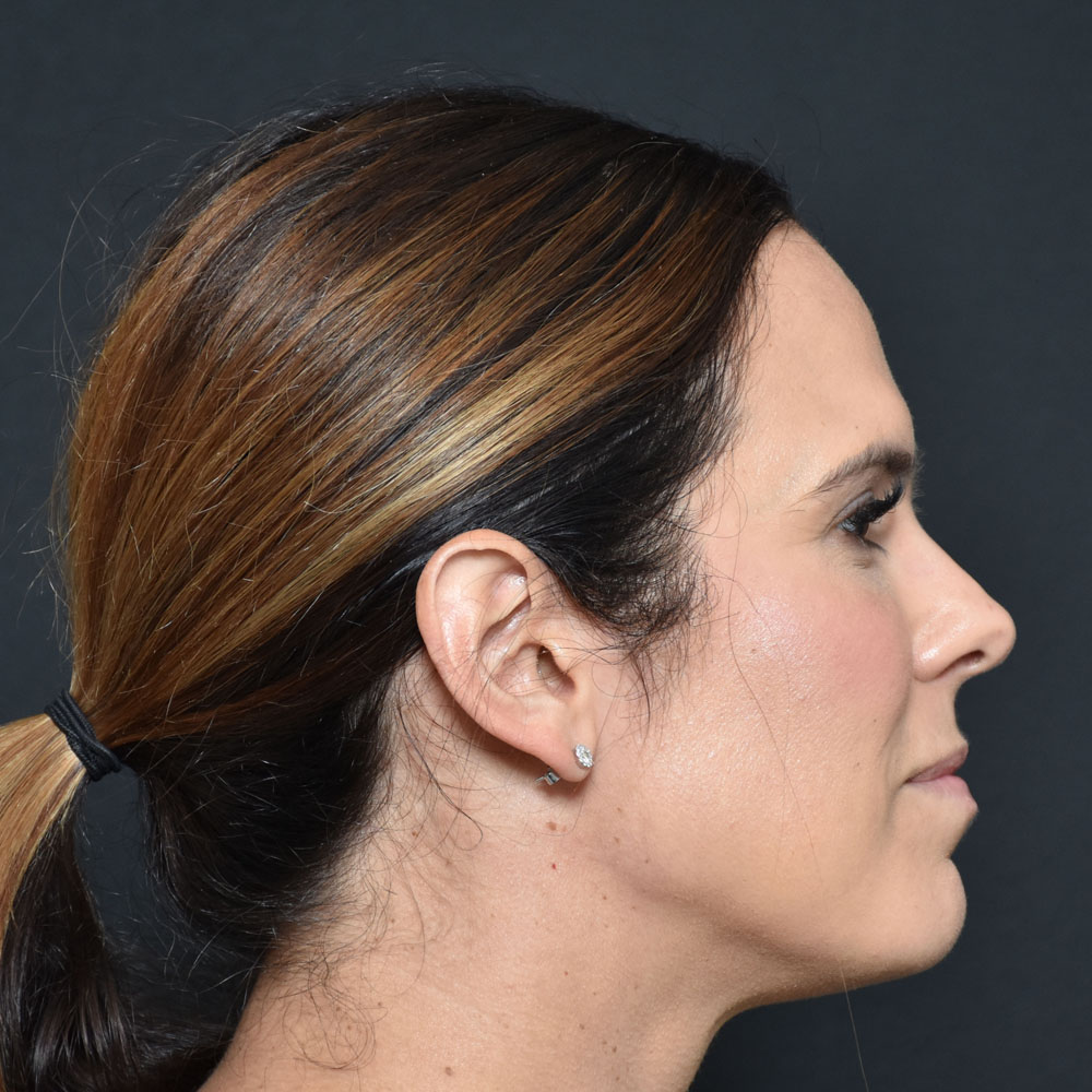 Case--2155 | After Facial Fillers 3