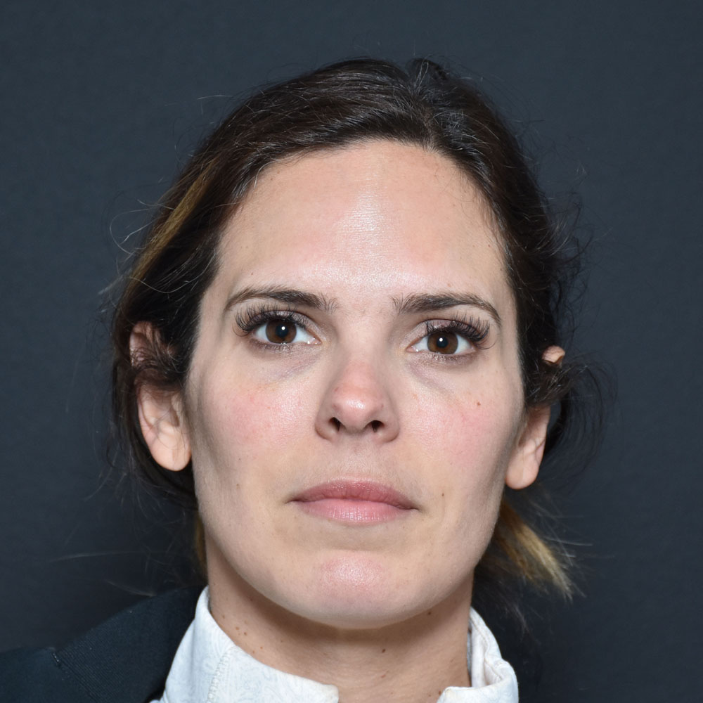 Case--2155 | Before Facial Fillers