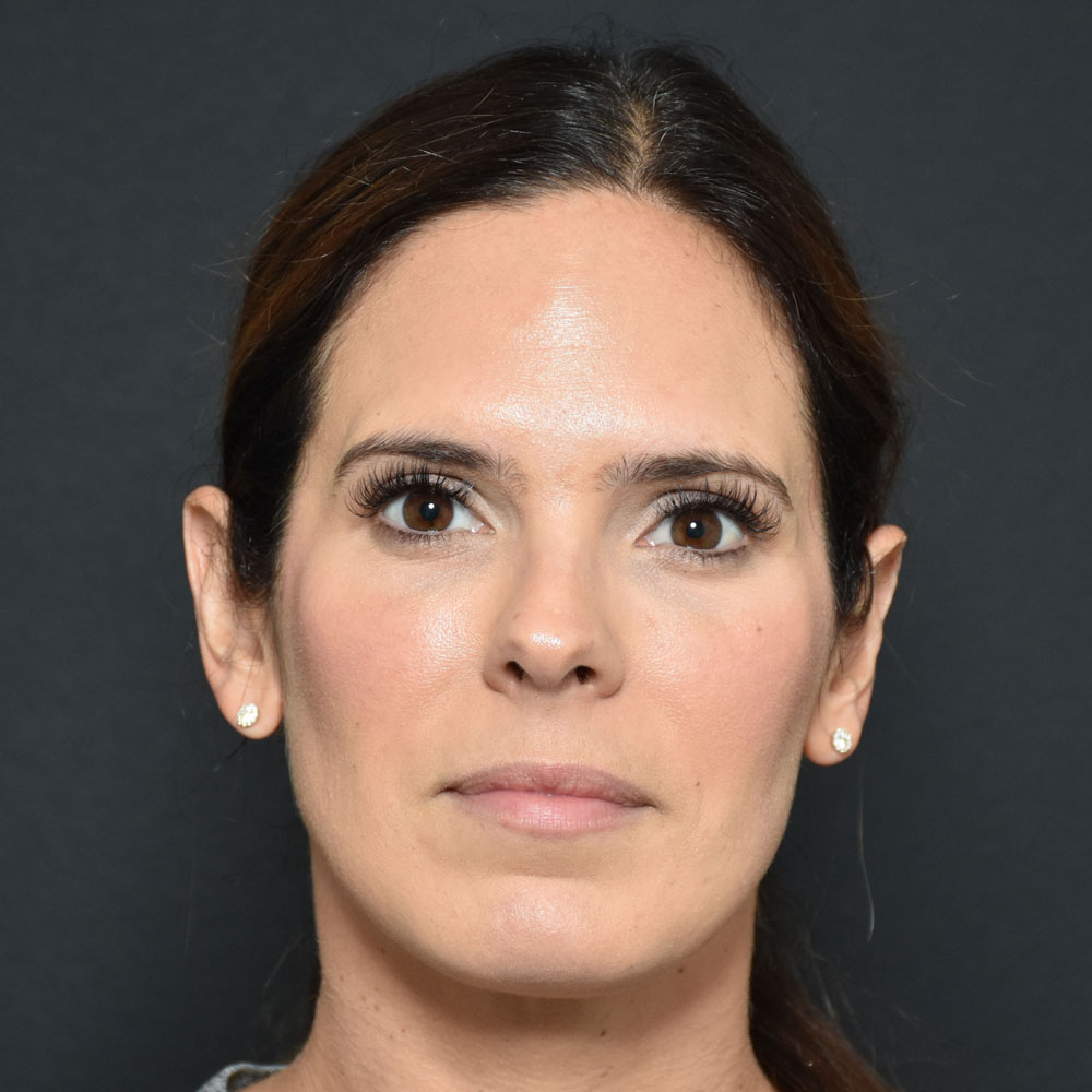 Case--2155 | After Facial Fillers