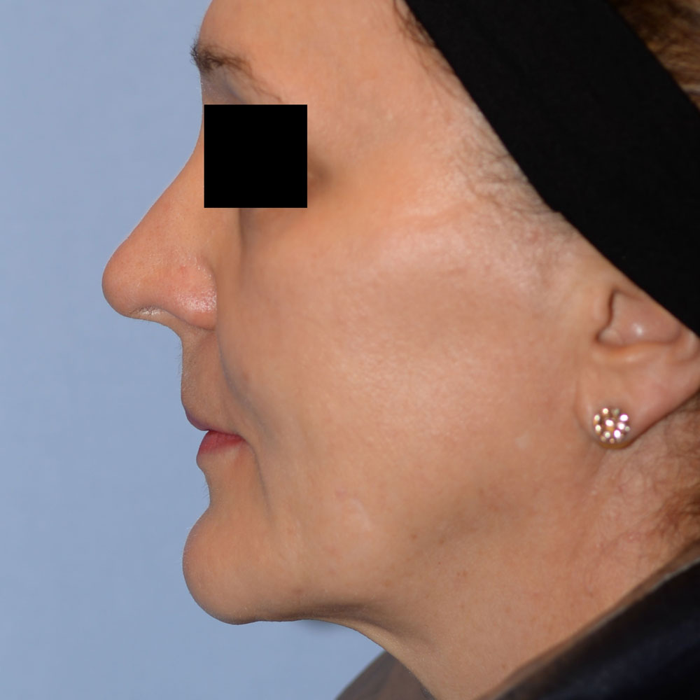 Case--2156 | Before Facial Fillers 2