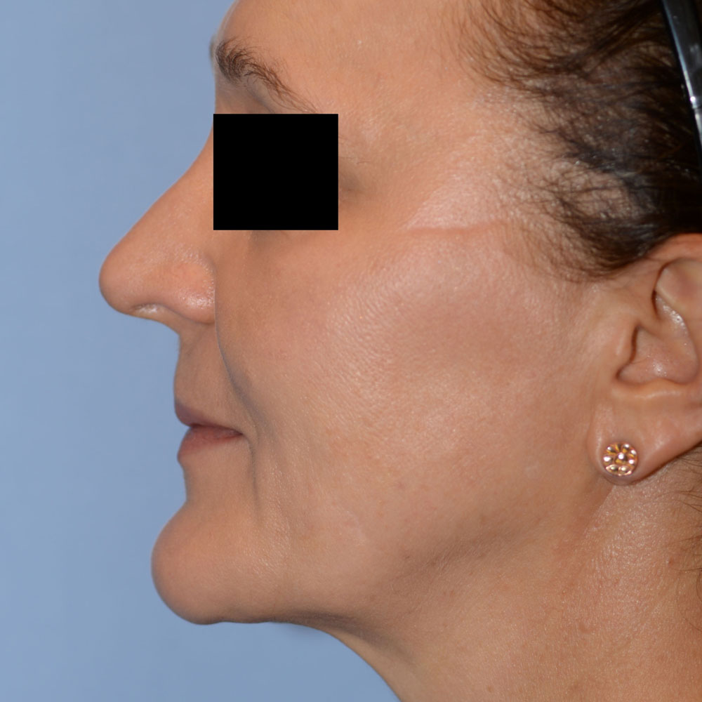 Case--2156 | After Facial Fillers 2