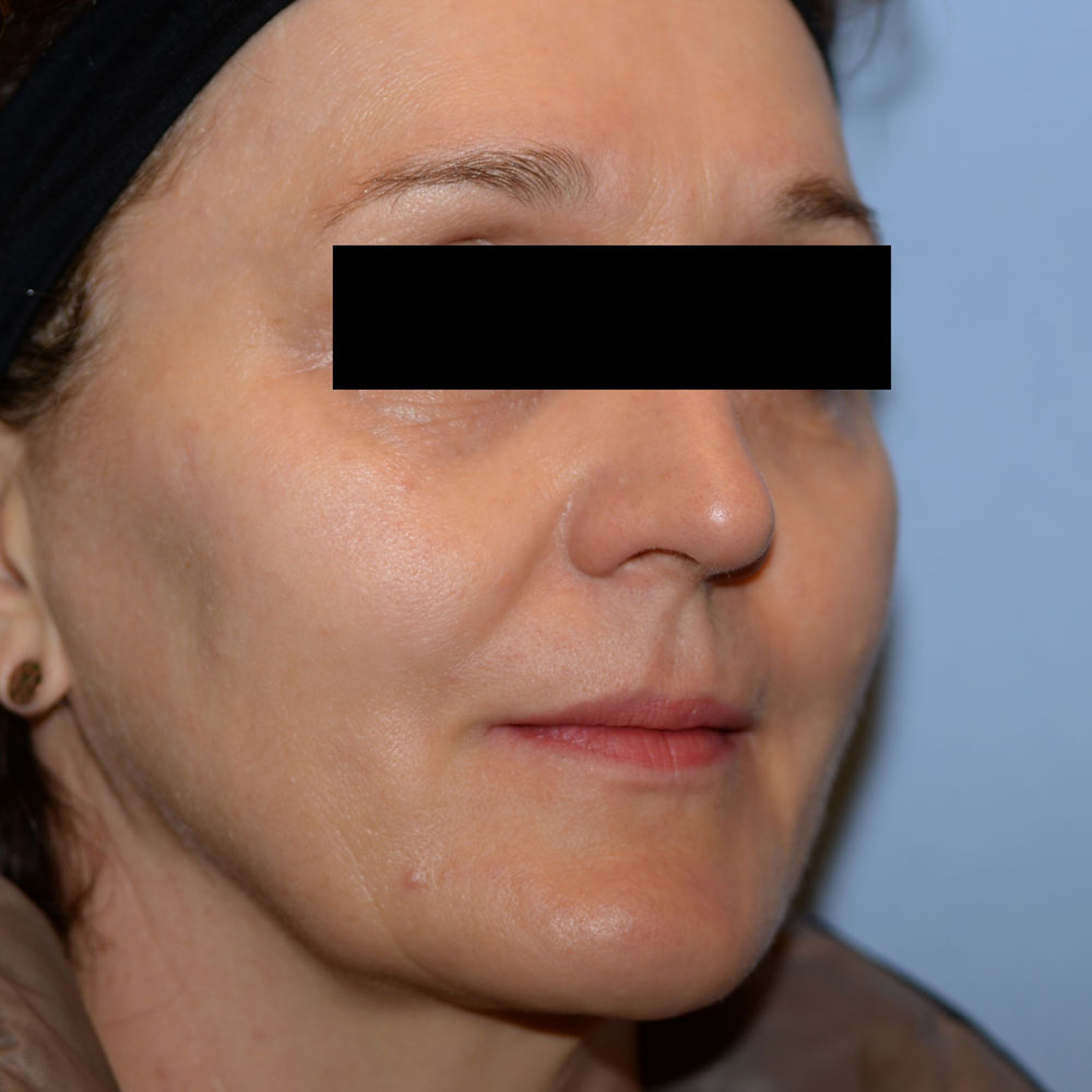 Case--2156 | Before Facial Fillers 3