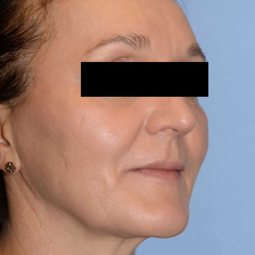 Case--2156 | After Facial Fillers 3