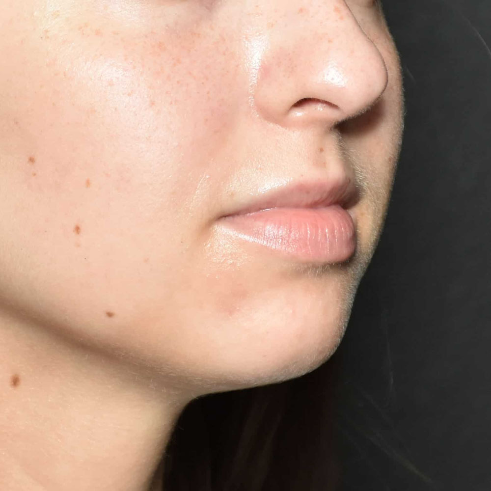 Case--2141 | Before Facial Fillers