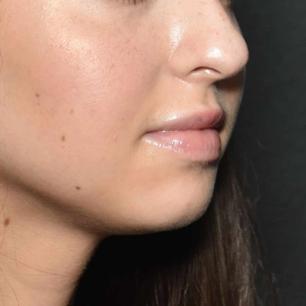 Case--2141 | After Facial Fillers