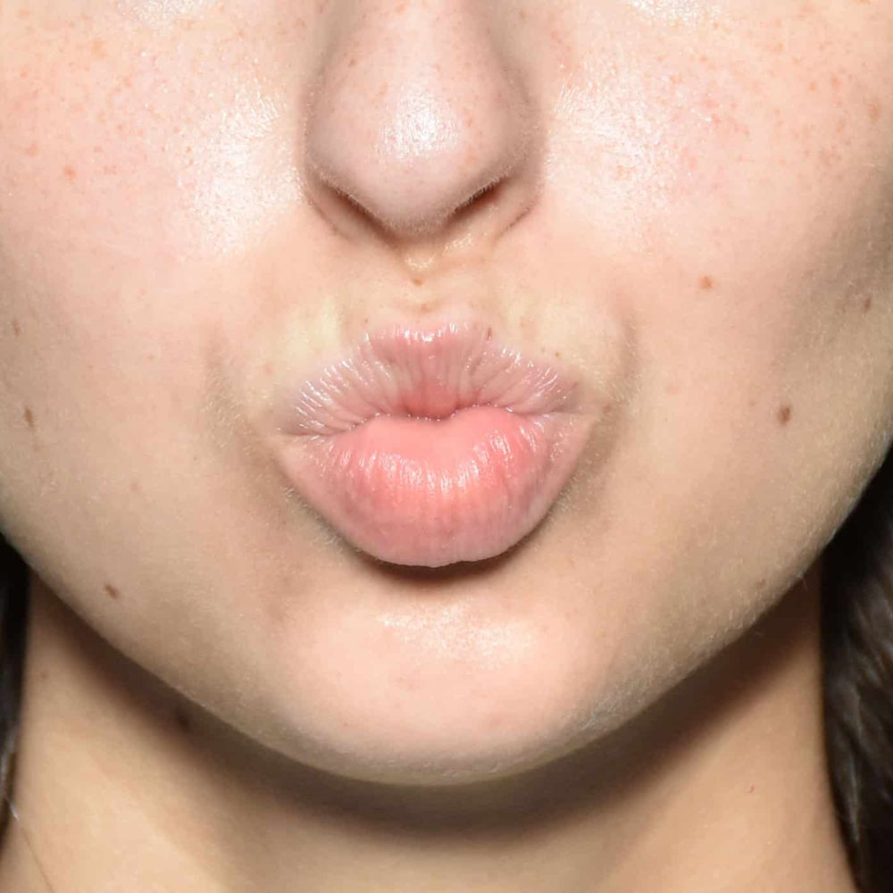 Case--2141 | Before Facial Fillers 2