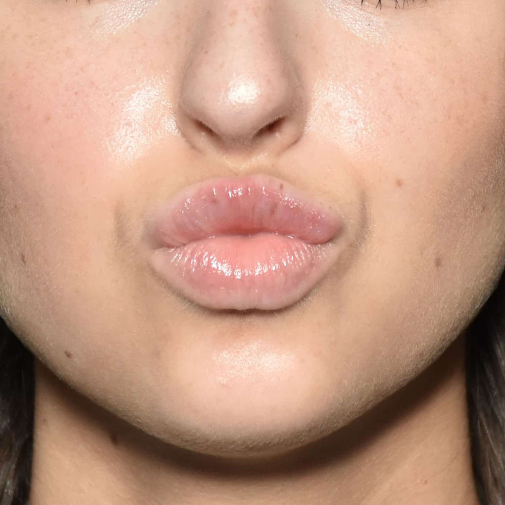 Case--2141 | After Facial Fillers 2