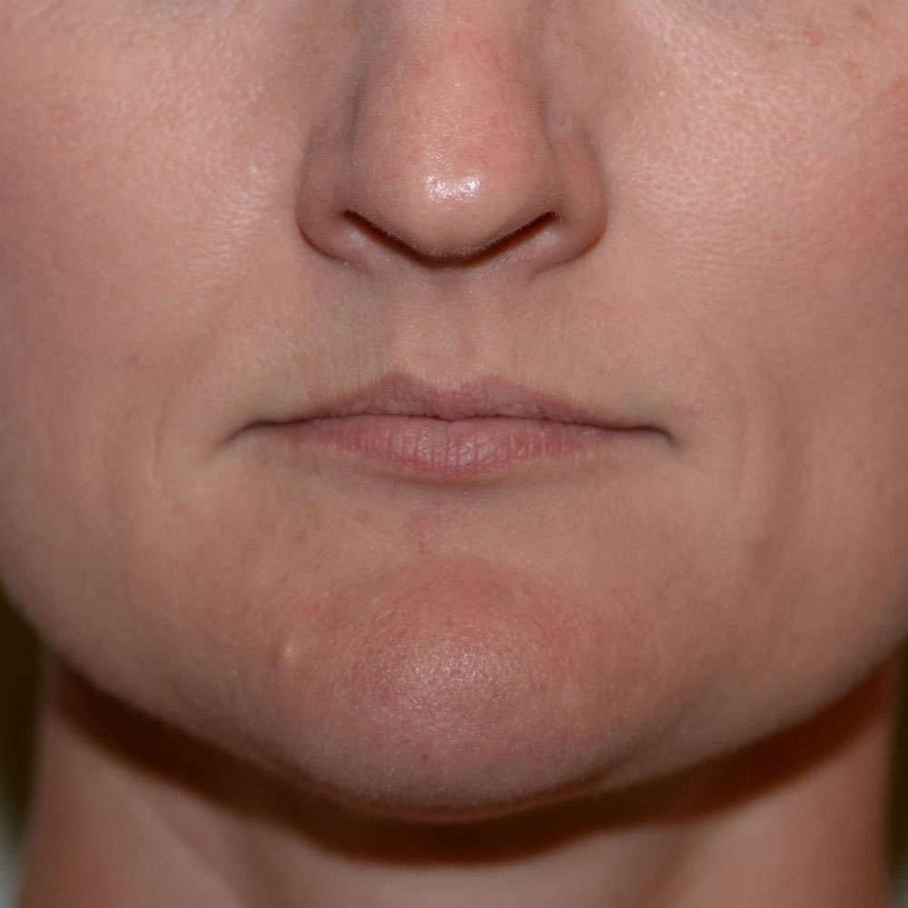 Case--2141 | Before Medspa