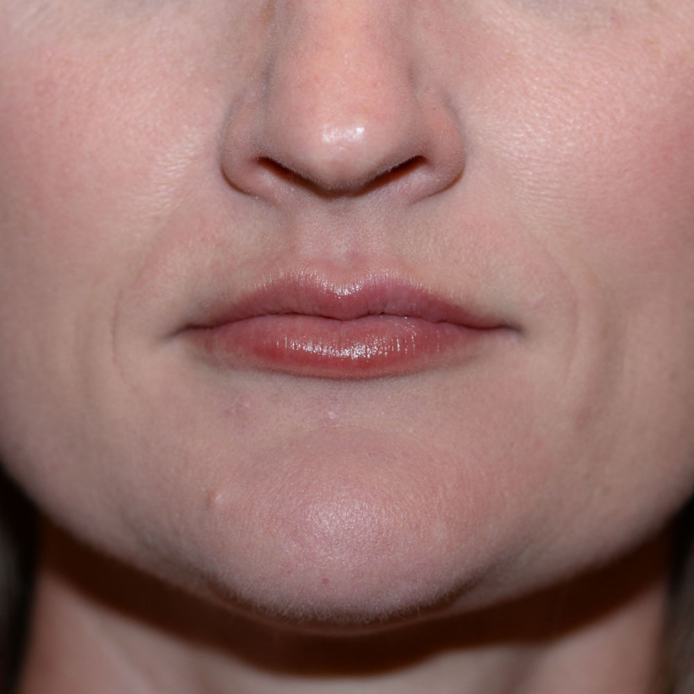 Case--2141 | After Medspa