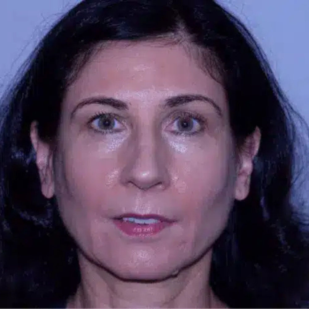 Case--2143 | After Medspa