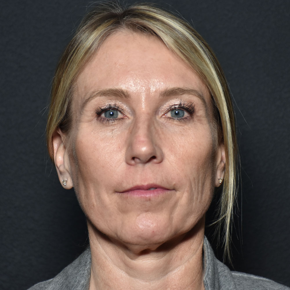 Case--2144 | Before Medspa