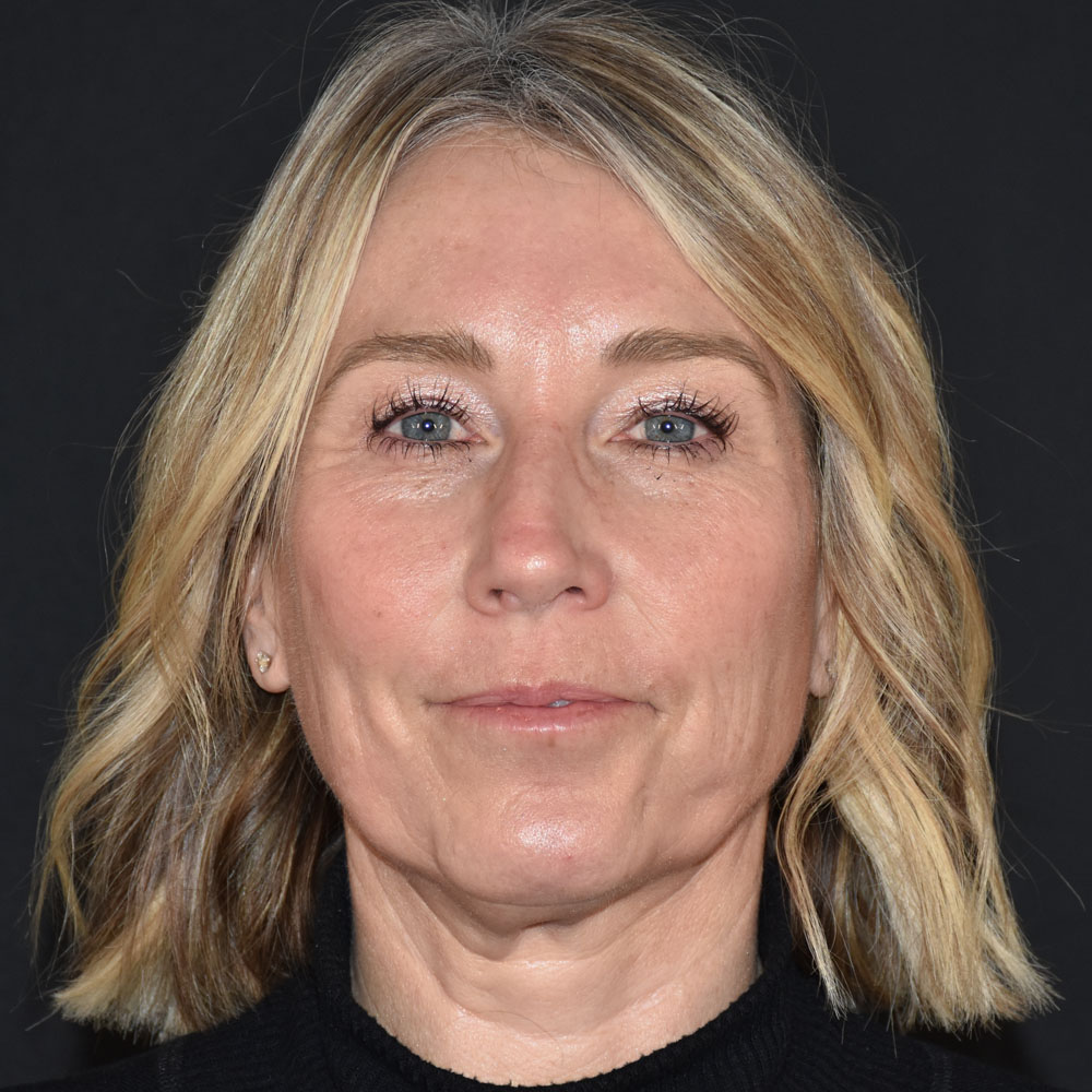 Case--2144 | After Medspa