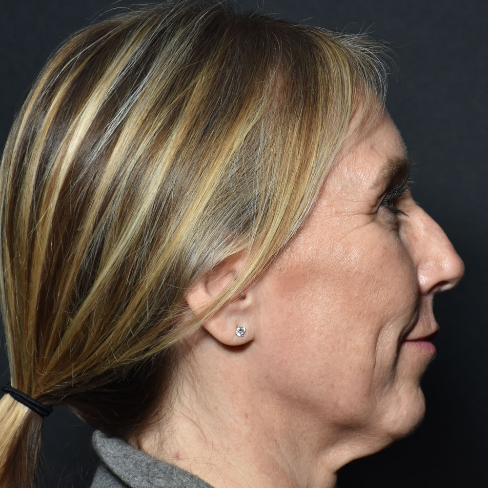 Case--2144 | Before Facial Fillers 2