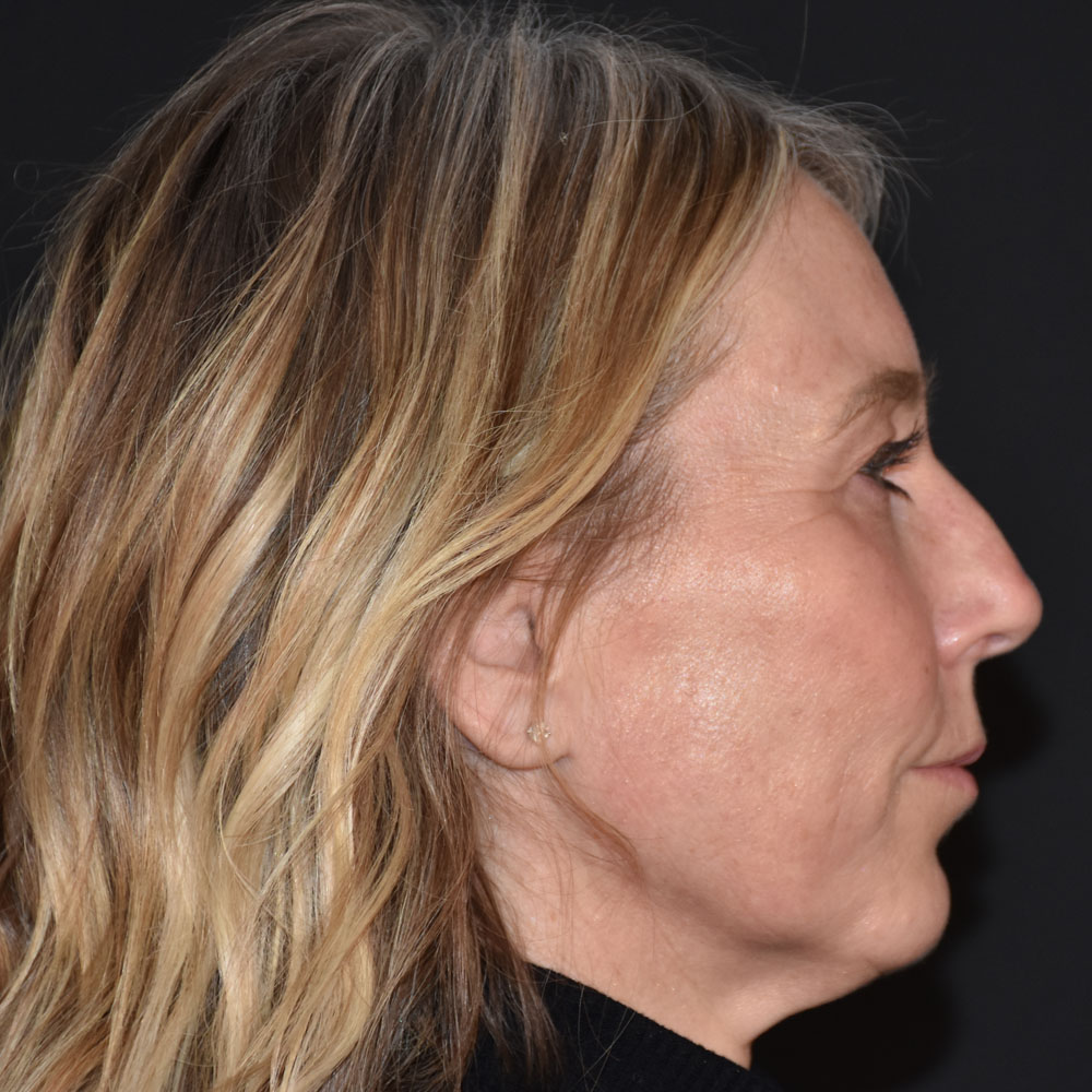 Case--2144 | After Facial Fillers 2