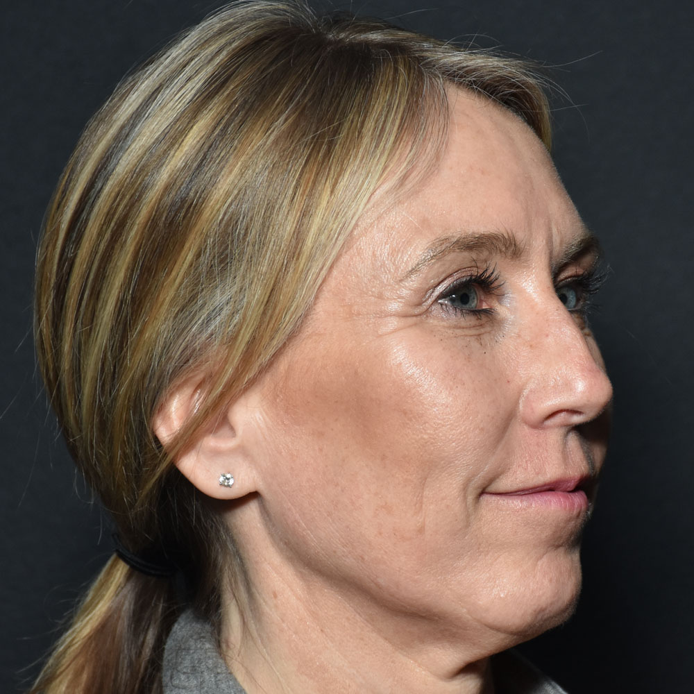 Case--2144 | Before Facial Fillers 3