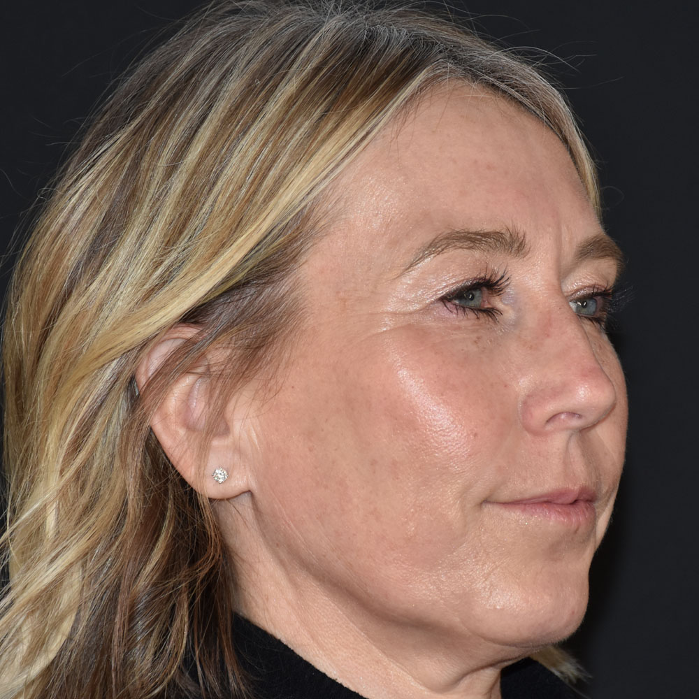 Case--2144 | After Facial Fillers 3