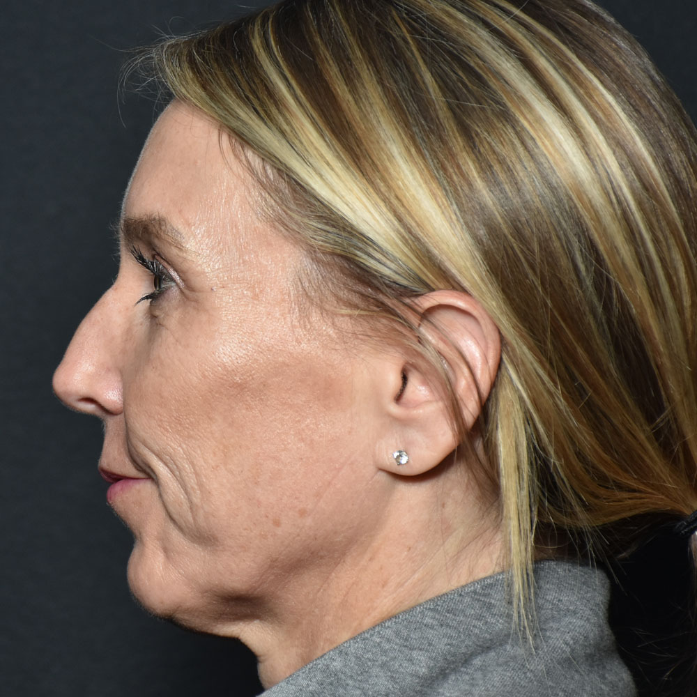 Case--2144 | Before Facial Fillers 4