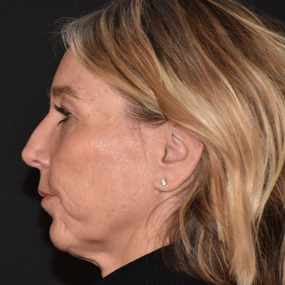 Case--2144 | After Facial Fillers 4