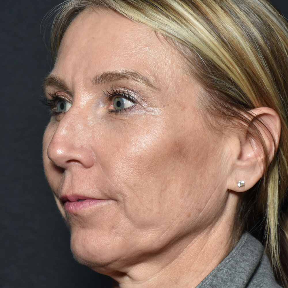 Case--2144 | Before Facial Fillers 5