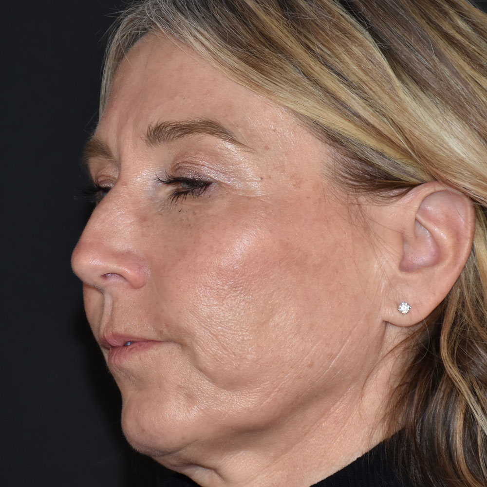 Case--2144 | After Facial Fillers 5