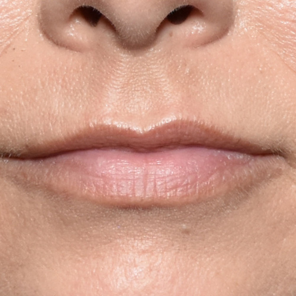 Case--2146 | Before Facial Fillers 2