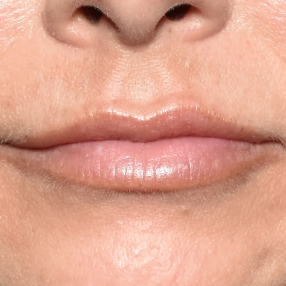 Case--2146 | After Facial Fillers 2