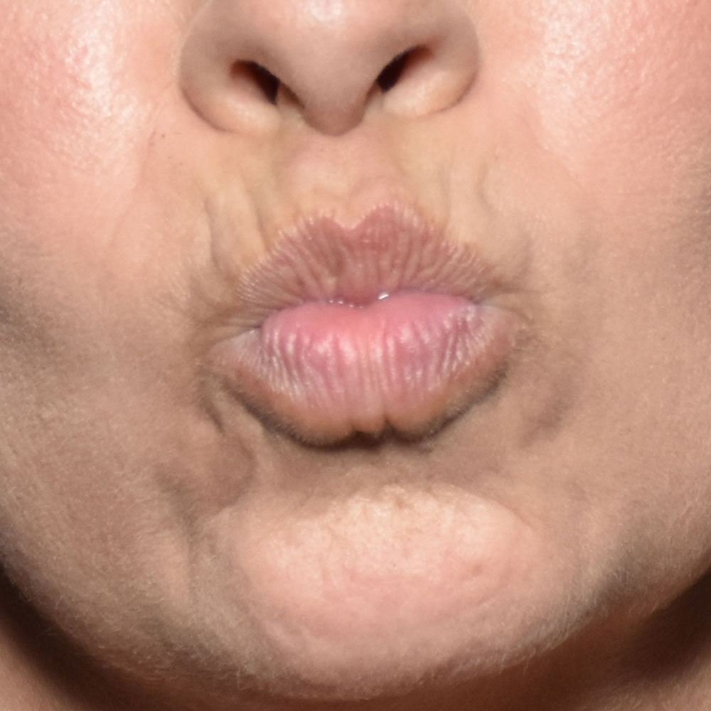 Case--2146 | Before Medspa