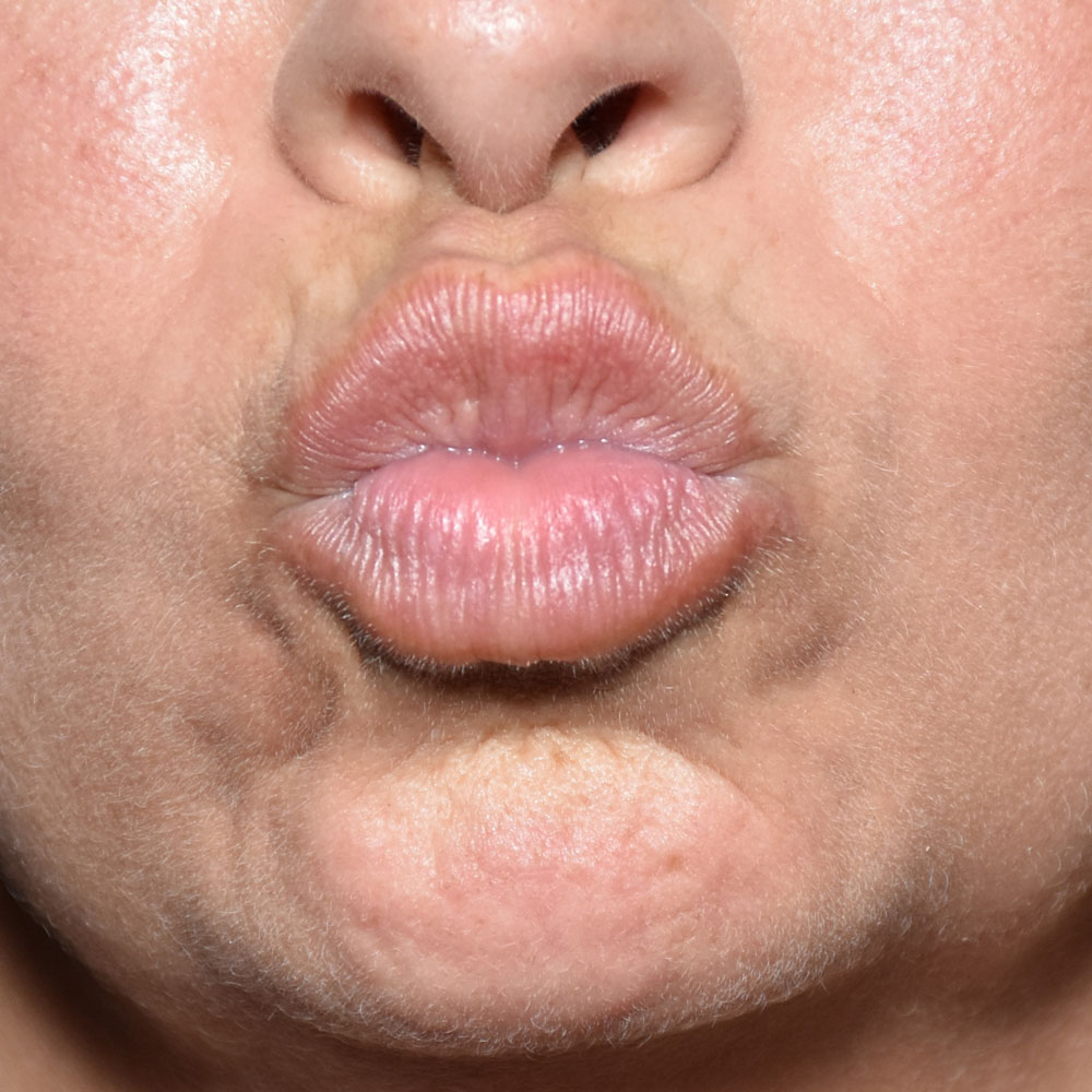 Case--2146 | After Medspa