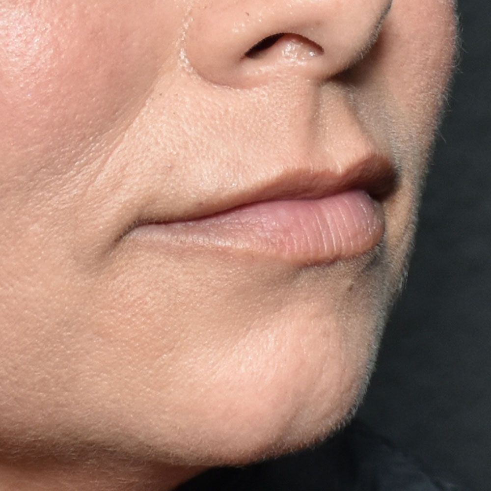 Case--2146 | Before Facial Fillers 3